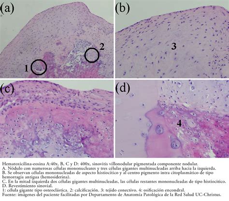 Tratamiento artroscópico de sinovitis villonodular pigmentada de