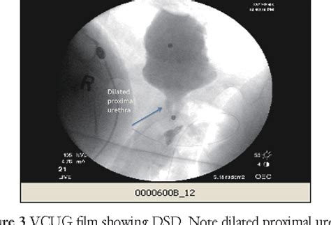 Figure 2 from Detrusor sphincter dyssynergia: a review of physiology ...