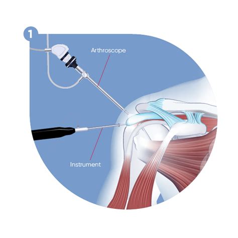 Tendinopathie de la Coiffe des Rotateurs Chirurgie de lépaule et du