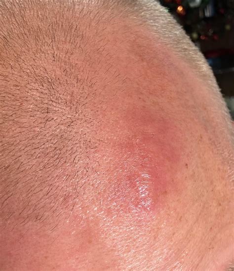 Forehead Lump Rash Should I See A Doctor R Dermatologyquestions