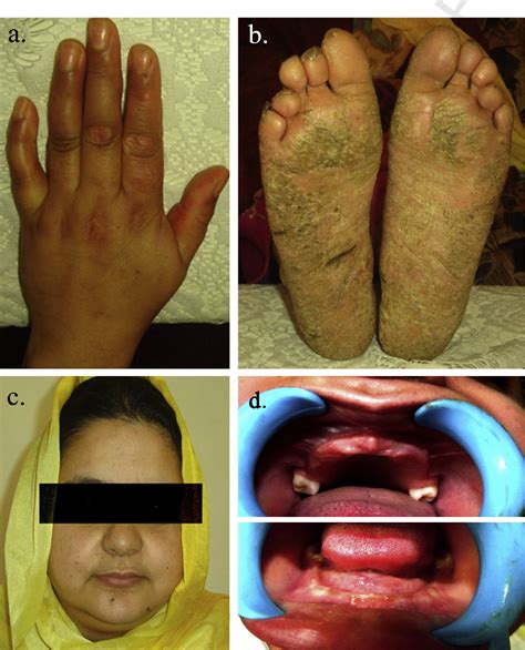 Papillon Lefevre Syndrome Reporting Consanguinity As A Risk Factor