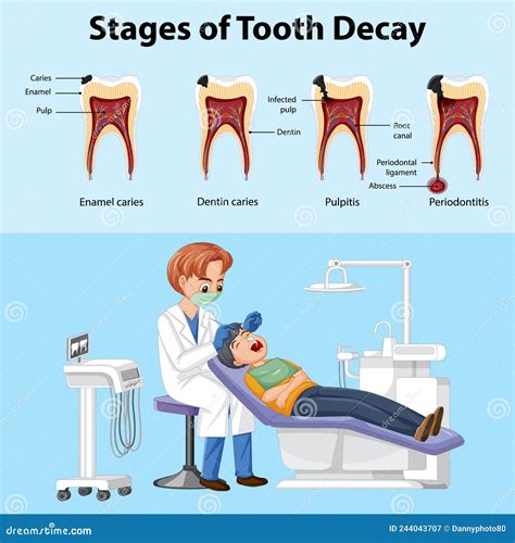 The Stages Of Tooth Decay Flat Vector Illustration Set