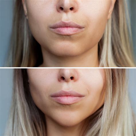 Buccal Fat Removal Cost México Transform Your Facial Contours