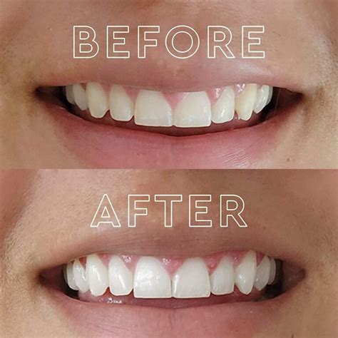 Teeth Whitening Toothpaste Alternatives For A Brighter Smile