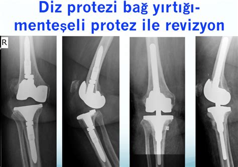 Diz Protezi Revizyonu