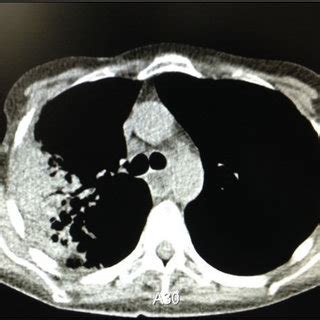 mycobacterium goodii pneumonia  unusual