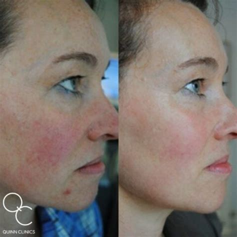 IPL Laser Facial Treatment Review Quinn Clinics Bristol