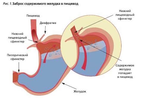 Заброс желудочного сока в пищевод: лечение, причины, симптомы