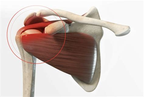 Symptômes et diagnostic de la tendinite de l épaule Dr Paillard