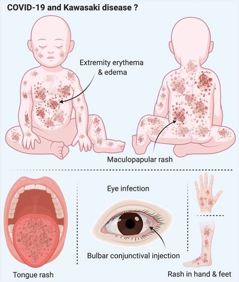 SARS-CoV-2 and Kawasaki disease. SARS-Cov-2 infected pediatric patients ...