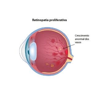 O que causa a retinopatia diabética Conheça a doença