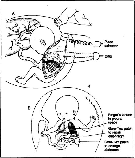 Congenital Diaphragmatic Hernia Repair