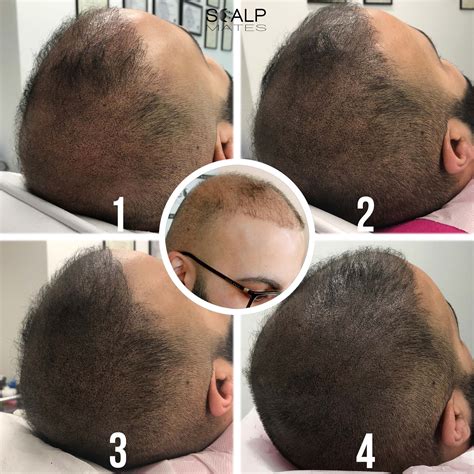 Our Clients ️ it | Before & After Scalp Micropigmentation for Men