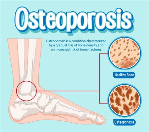 Osteogenesis Imperfecta – Types, Symptoms, & Treatment Options