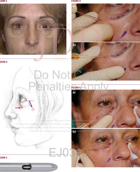 Figure 3 From The Use Of Blunt Tipped Cannulas For Tear Trough