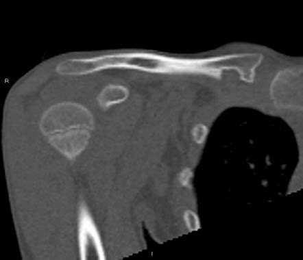 Rhomboid fossa of the clavicle | Radiology Case | Radiopaedia.org