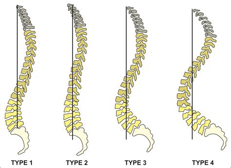 Scielo Brasil Spinopelvic Sagittal Balance What Does The Radiologist Need To Know