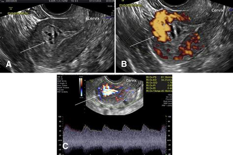 Ultrasound Diagnosis And Management Of Acquired Uterine Enhanced