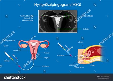 7 X Ray Dye On Uterus Images, Stock Photos, 3D objects, & Vectors ...