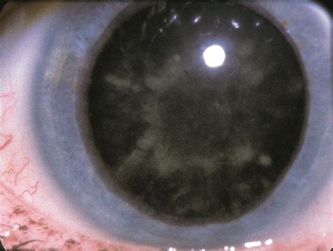 Types of cataracts - The Cataract Course