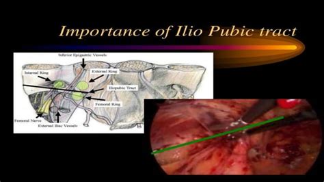 Laparoscopic Anatomy Of Inguinal Hernia Ppt