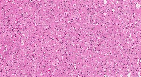 Oncocytoma of the kidney | Ottawa Atlas of Pathology