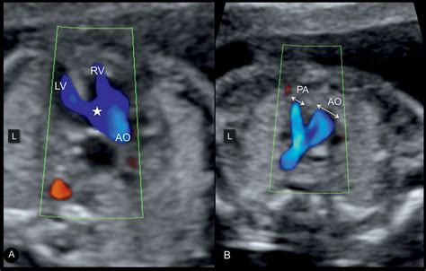 Tetralogy Of Fallot Pulmonary Atresia With Ventricular Septal Defect Porn Sex Picture