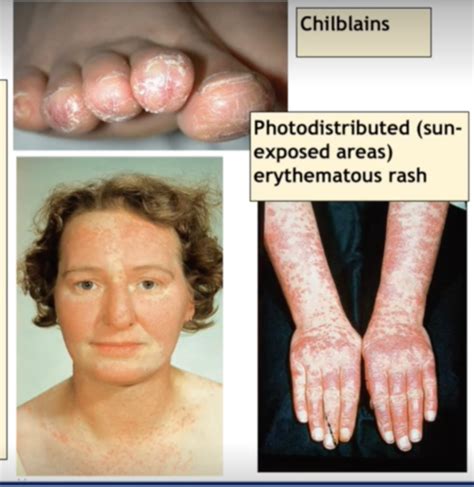 Derm The Skin In Systemic Disease Flashcards Quizlet