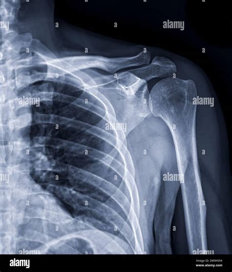 X-ray of Shoulder joint for diagnosis shoulder joint from dislocation or fracture Stock Photo ...