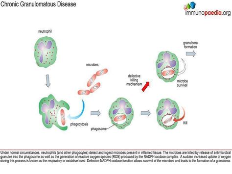 Chronic Granulomatous Disease Case Study Immunopaedia