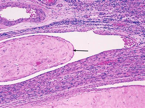 Microscopic Appearance Of Intravenous Leiomyomatosis In Patient H E