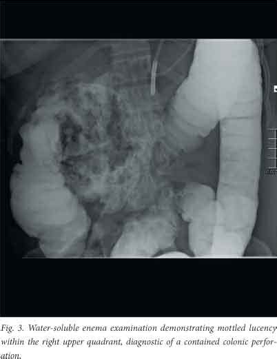 Colonic Perforation Following Endoscopic Retrograde Cholangiopancreatography Associated Pancreatitis