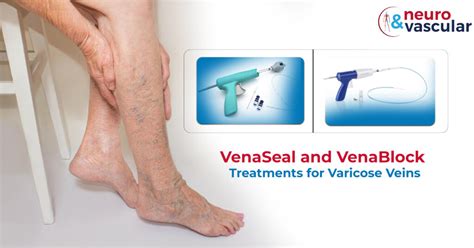 Vena Block VenaSeal Treatments For Varicose Veins