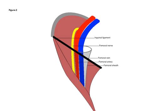 Femoral Nerve Paralysis Following Open Inguinal Hernia Repair