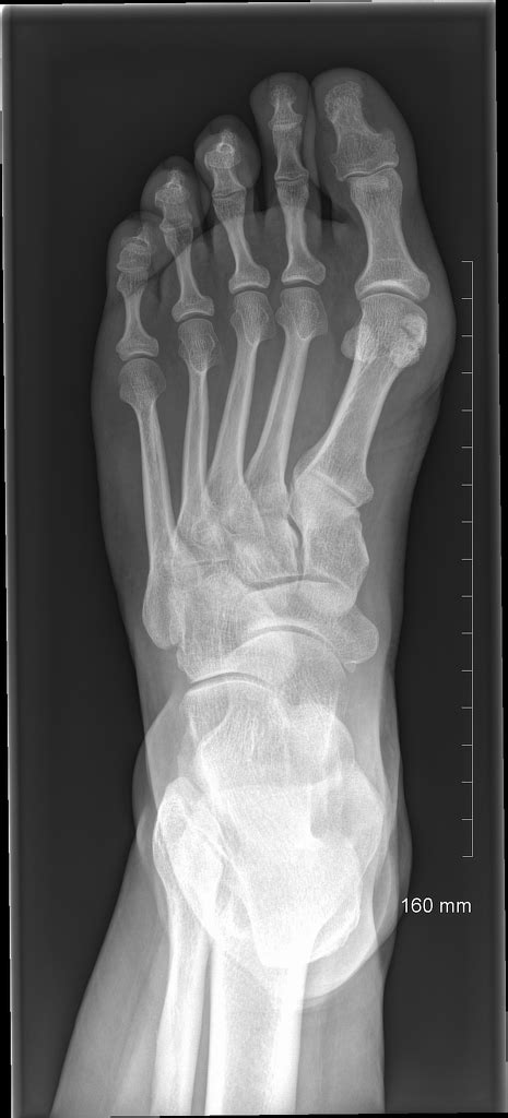 Sesamoid Bone Fracture