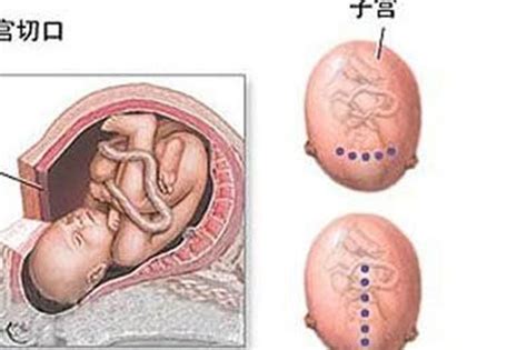 女人一生最多能承受几次“剖宫产”？一胎剖了二胎可不可以顺！