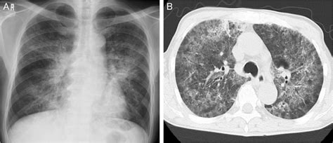 Chest Radiographs A Chest X Ray Revealed Infiltration Shadows In