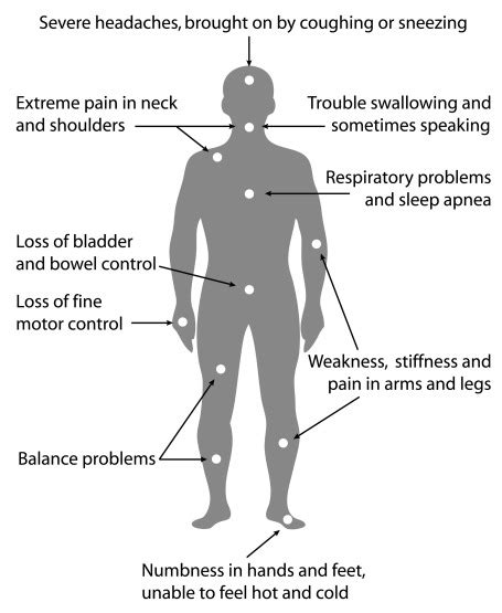 Chiari Malformation In Pregnancy Nursing For Womens Health