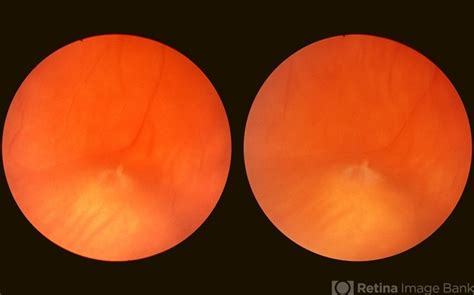 White Retinal Tuft - Retina Image Bank