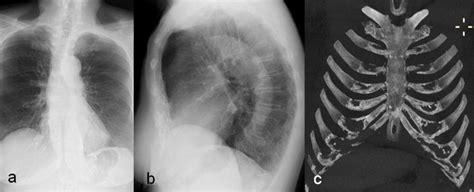 Lateral Chest X Ray A And Mpr Sagittal Reconstruction B Show A