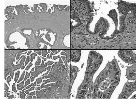 Cervical Villoglandular Adenocarcinoma Semantic Scholar