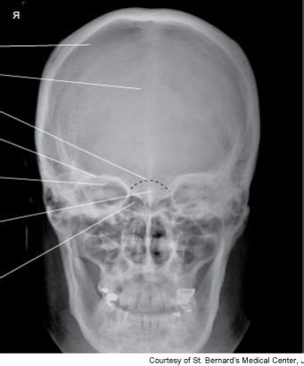 Ap Skull With Perpendicular Central Ray Radiograph Diagram Quizlet