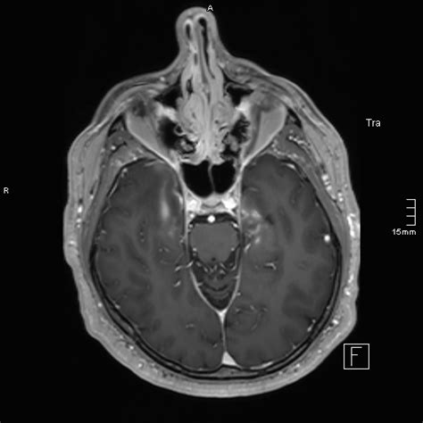 Neurosarcoidosis Involvement Of The Mesial Temporal Lobes Image