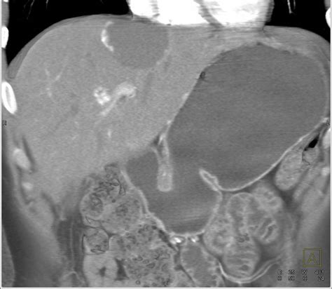 Cavernous Hemangioma Of The Liver Liver Case Studies Ctisus Ct Scanning