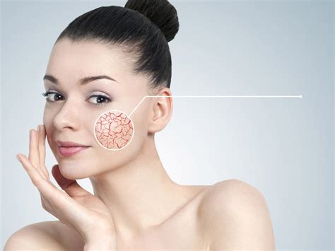 Мази при куперозе на лице - симптомы, диагностика, лечение