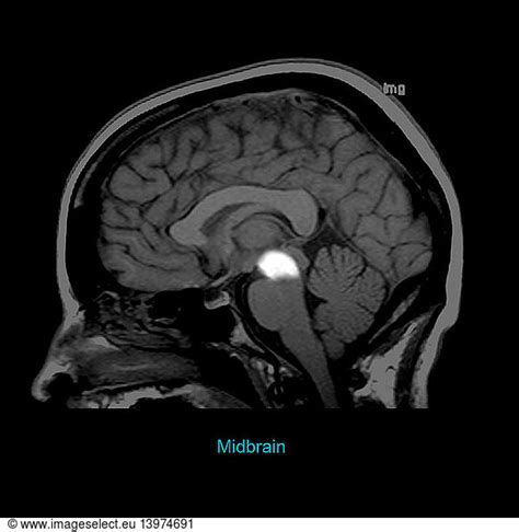 Midbrain Midbrain Sagittal Mribrain Anatomybrainbrain Region