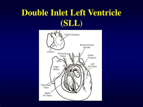 PPT - Double Inlet Ventricle PowerPoint Presentation - ID:282508