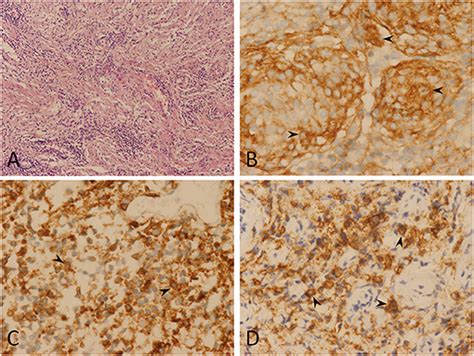 Frontiers Case Report Creeping Growth In Lymphoplasmacyte Rich