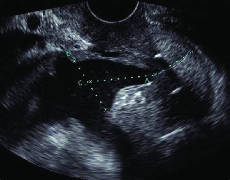 Cervical measurement obtained after cerclage placement. (A) total ...