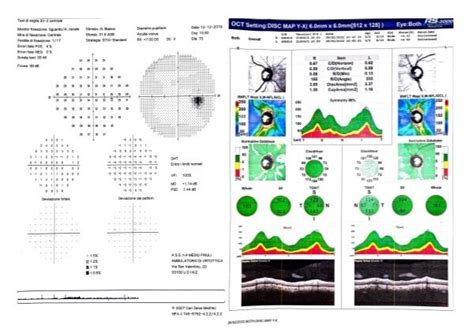 Figure Normal Visual Field And Optical Statpearls Ncbi Bookshelf